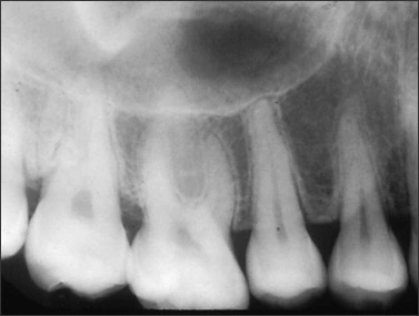 Normal Radiographic Appearance of the Supporting Structures of the Teeth - Figure 6