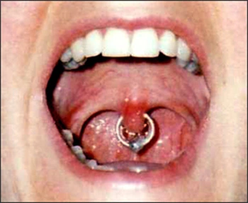 Image: Uvula piercing