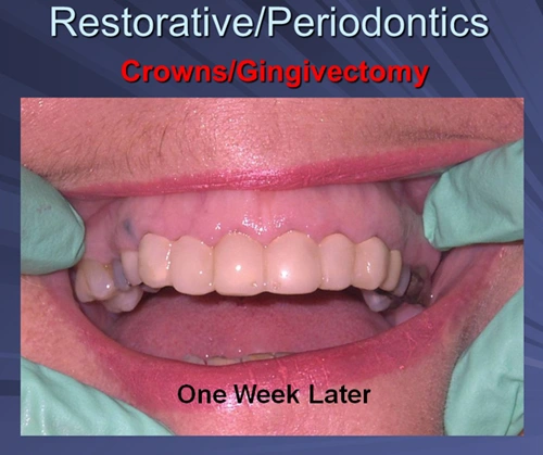 This image depicts teeth that were temporized with a chair-side fabricated six unit splint and the patient returned for impressions one week later.