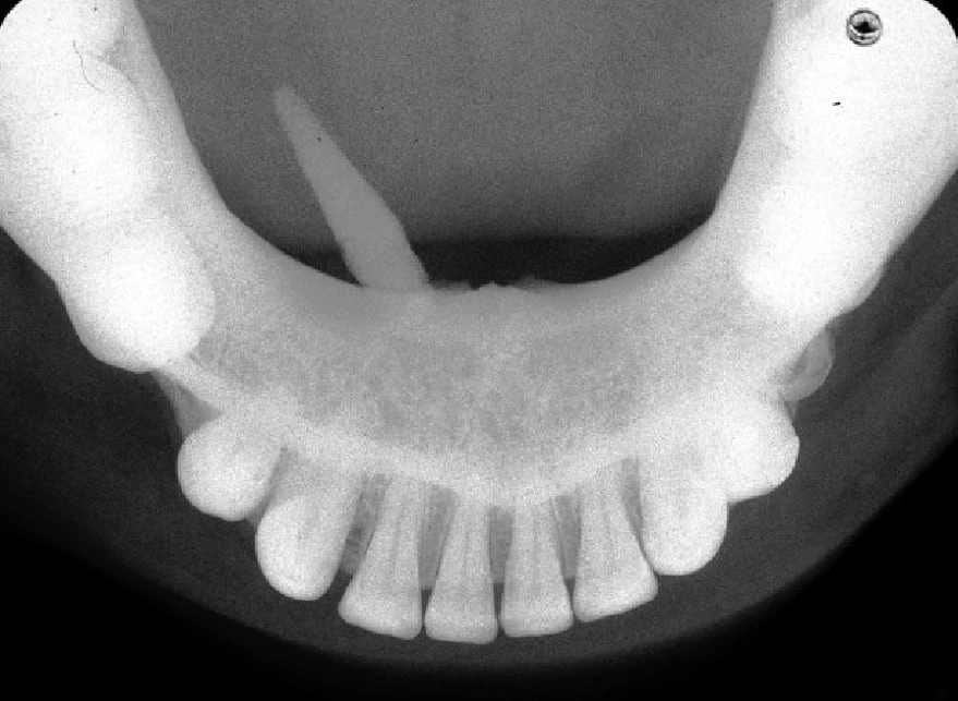 Figure 6. Occlusal Image of a Sialolith.