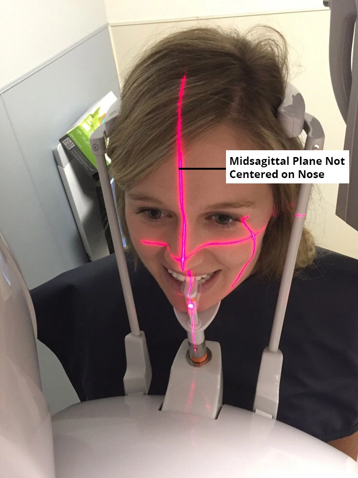 Image of incorrect patient positioning, because the midsagittal plane is not centered along the midline of the face.