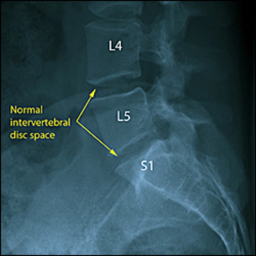 Image of intervertebral disc space.