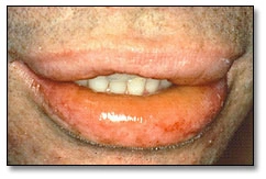 Image: Anaphylactic reactions to latex allergens in the oral healthcare setting characterized by angioedema of the lips and oropharynx associated with stridor, wheezing, hypotension, and tachycardia.