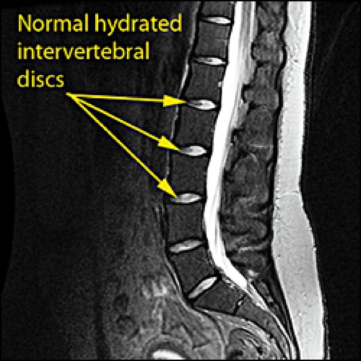 Image of normal discs.