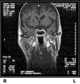 Front view MRI of patient's head