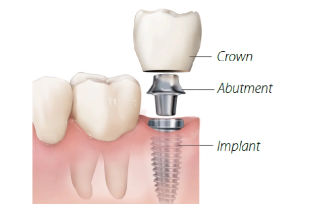 Patient Education - Implant Care