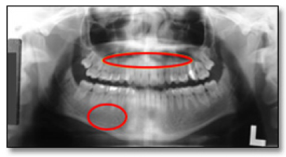 pterygoid plate radiograph