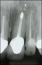 fig03-periapical-xray