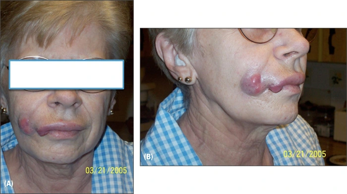 Photos showing front and side facial views of patient with mass on right cheek