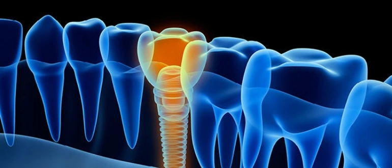 Caring for your dental implants