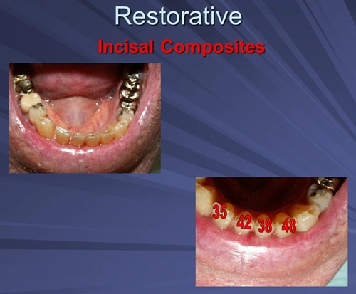 This image depicts incisal composites Diagnodent indicate incisal dentin caries in medication induced xerostomic patient.