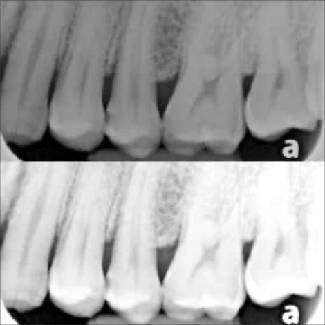 A History and Update of Fluoride Dentifrices