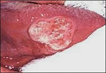 Image showing squamous cell carcinoma