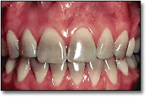 ce4 - Content - Discolored Teeth - Figure 4