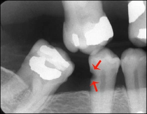 Root Surface Caries