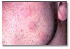 Image: Acute urticaria characterized by pruritic, red wheals that range from 1.5 to 3.0 cm in diameter, which began about an hour after exposure to latex gloves.