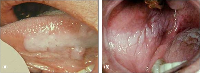 Photo showing mass on right side of cheek and tongue.