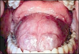 Image: Epidermoid/dermoid cyst