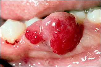 buccal view of gingival mass
