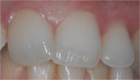 Photo of teeth with no ETW