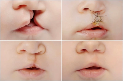 ce534 - Content - Impact of Tobacco Use in the Oral Cavity - Figure 1