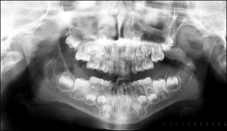 fig02-3mnth-pan-xray