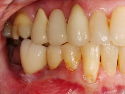 ce610 - Content - Peri-implant Diseases and Conditions - Figure 1
Image Courtesy of Dr. C. Cobb.