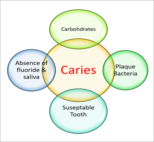 Factors in the Dental Caries Process - Food for Thought: The ...