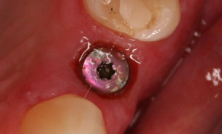 ce514 - Content - Peri-implant Anatomy and Biology - Figure 1