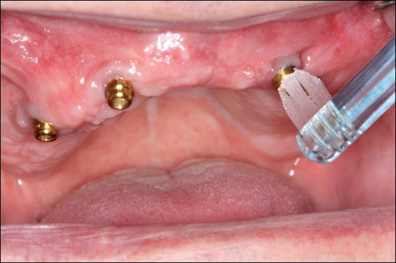 Photo showing individual stud attachments for easier oral hygiene maintenance