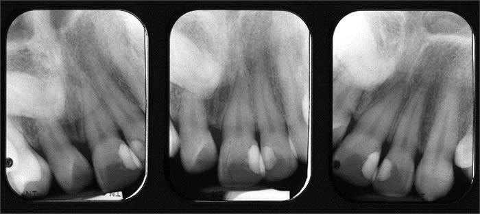 Periapical radiographs of distoangular horizontal impaction of maxillary central incisor #8.