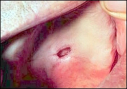 Image: Necrotizing sialometaplasia