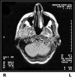 Top view MRI of patient's head