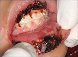 Image: Erythema multiforme