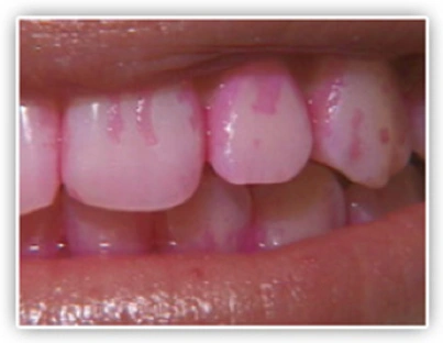 ce542 - Content - Dental Plaque/Biofilm - Figure 1