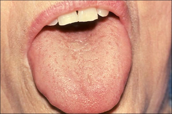 Photo showing an example Sjögren’s Syndrome.