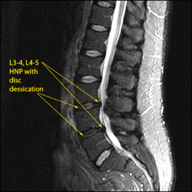 Image of disc herniation.
