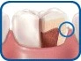 Patient Material - ¿Cómo se producen las caries? - How Do You Get Cavities? - Spanish - Image 3