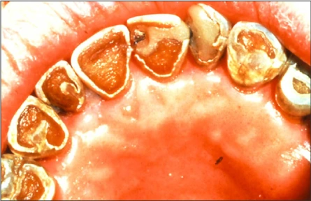 A distinctive form of rampant caries, termed “radiation caries”