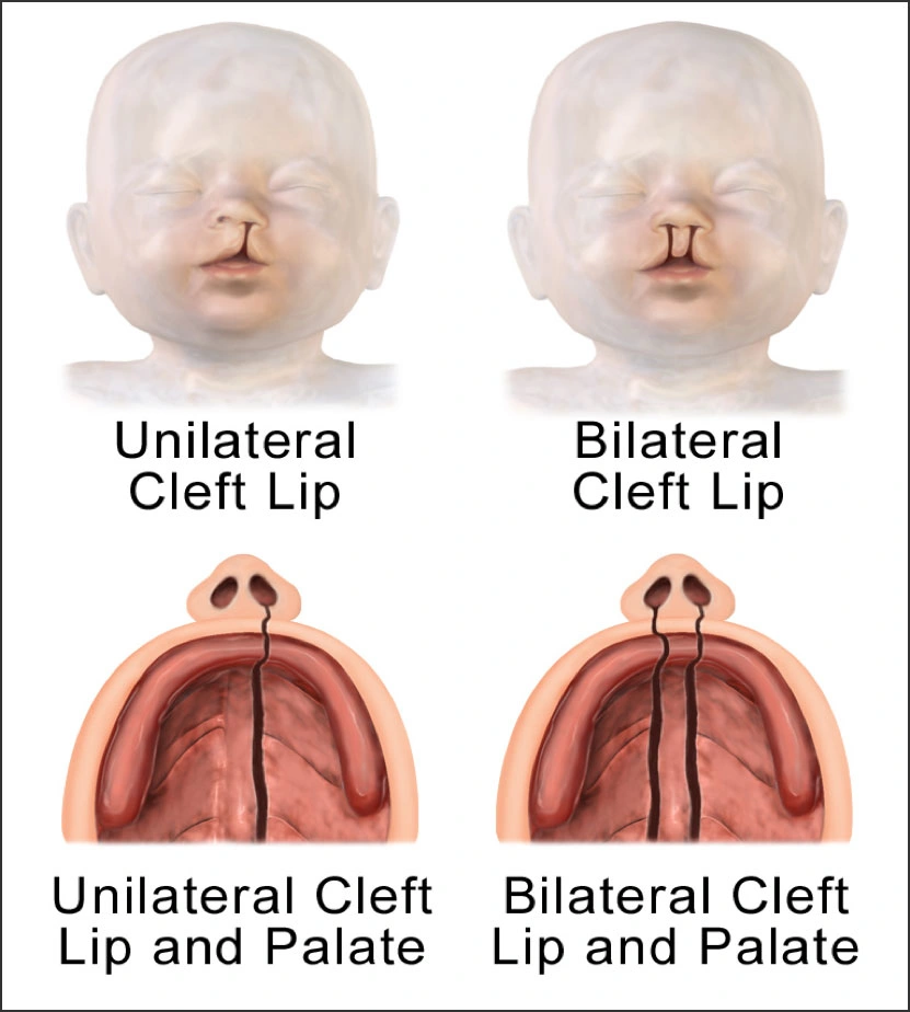 infant cleft palate