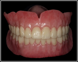 Conventional Complete Dentures | Digital Dentures | Continuing ...