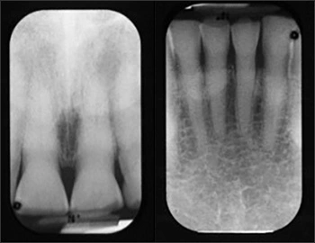 Periapical radiographs showing secondary dentin deposition likely due to attrition