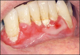 Image: Mucous membrane pemphigoid