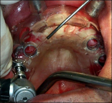 Photo showing implants placed through the 3D surgical guide.