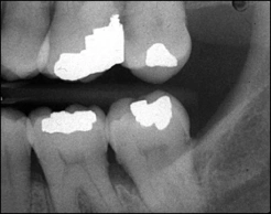 radiograph of horizontal overlapping