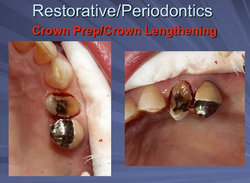 This image depicts the hard tissue crown lengthening can be done with a flapless approach if two millimeters or less of bone needs to be removed.