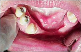 ce337 - Content - Floor of the Mouth - Figure 4