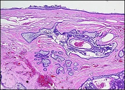 fig14-proliferating-connective-tissue