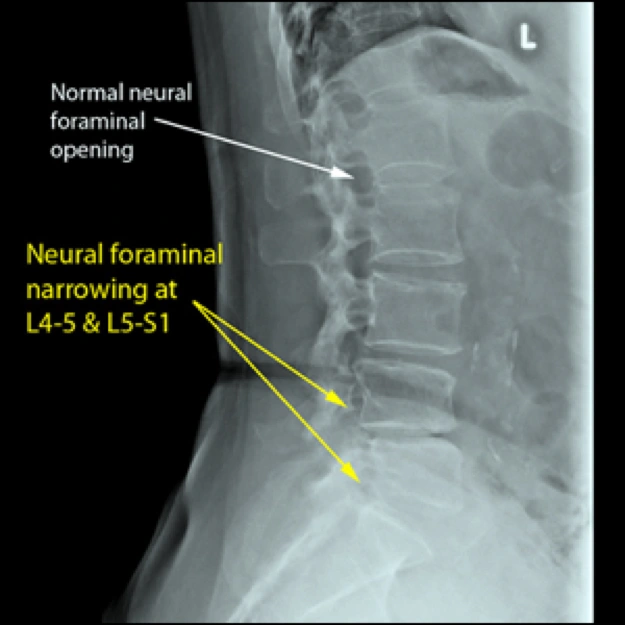 Image of neural foraminal stenosis.