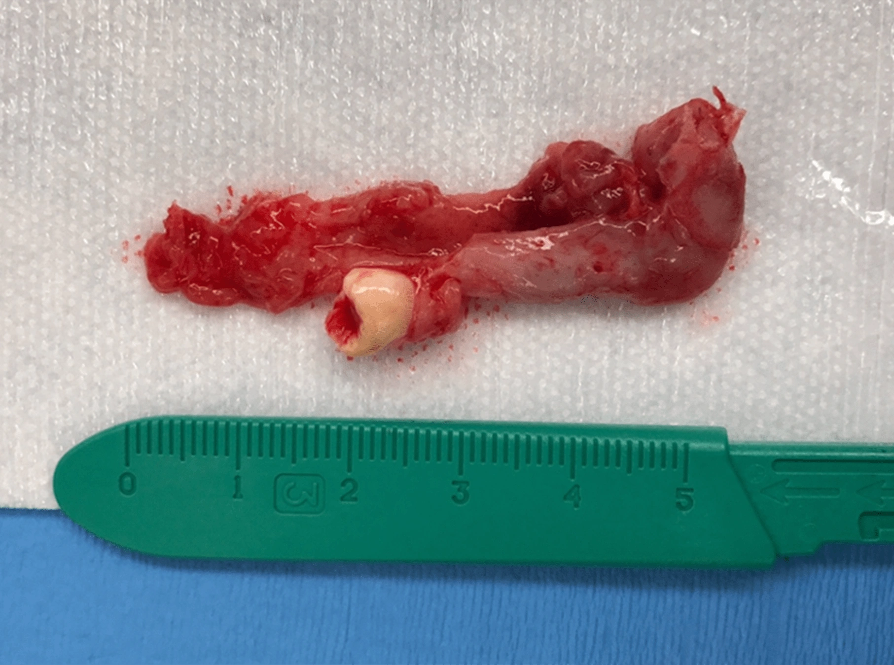 Figure 2. Dentigerous Cyst.